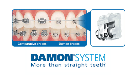 OS Ceramic Braces Damon2