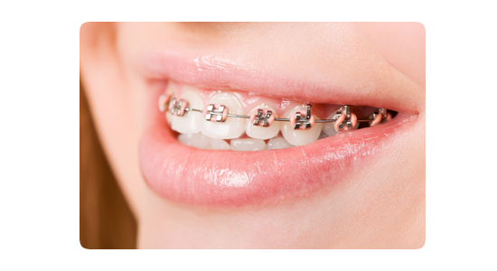 OS Invisalign Page design2