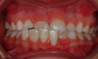 Patient 2 | The Orthodontic Studio Before Photo