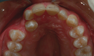 Patient 3 | The Orthodontic Studio Before Photo