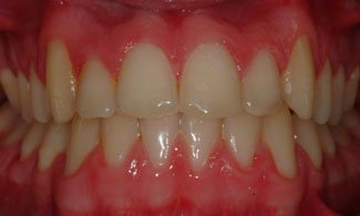 Patient 1 | The Orthodontic Studio After Photo