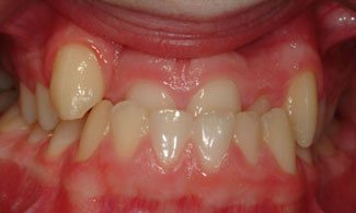 Patient 1 | The Orthodontic Studio Before Photo